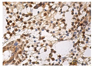  caspase-3 p17 (G-5): sc-166589. Immunoperoxidase staining of formalin fixed, paraffin-embedded human bone marrow tissue showing cytoplasmic and nuclear staining of hematopoietic cells.