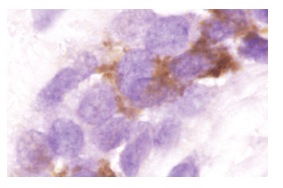  Daxx (S-20): sc-7001. Immunoperoxidase staining of formalin-fixed, paraffin-embedded human breast tumor showing cytoplasmic localization.