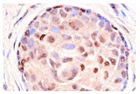  DNA-PK<sub>CS</sub> (C-19): sc-1552. Immunoperoxidase staining of formalin-fixed, paraffin-embedded human breast tumor showing nuclear staining.