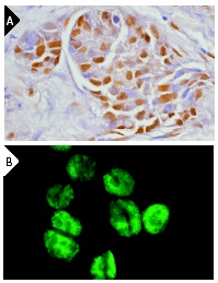  DNA-PK<sub>CS</sub> (H-163): sc-9051. Immunoperoxidase staining of formalin-fixed, paraffin-embedded human breast tumor (A) and immunofluorescence staining of methanol-fixed HeLa cells (B) showing nuclear localization.