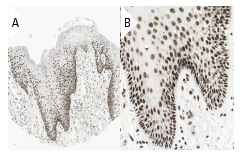  DNA-PK<sub>CS</sub> (H-163): sc-9051. Immunoperoxidase staining of formalin fixed, paraffin-embedded human oral mucosa tissue showing nuclear staining of surface epithelial cells at low (A) and high (B) magnification. Kindly provided by The Swedish Human Protein Atlas (HPA) program.