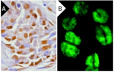  DNA-PK<sub>CS</sub> (H-163): sc-9051. Immunoperoxidase staining of formalin-fixed, paraffin-embedded human breast tumor (A) and immunofluorescence staining of methanol-fixed HeLa cells (B) showing nuclear localization.