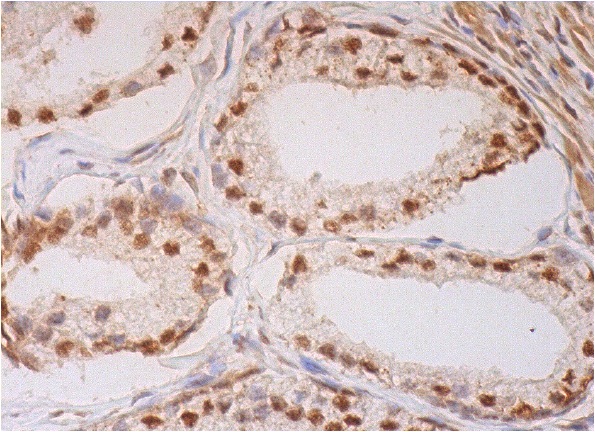  EMSY (A-15): sc-34995. Immunoperoxidase staining of formalin fixed, paraffin-embedded human prostate tissue showing nuclear and cytoplasmic staining of glandular cells.