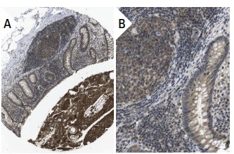  FADD (H-181): sc-5559. Immunoperoxidase staining of formalin fixed, paraffin-embedded human appendix tissue showing cytoplasmic staining of glandular and lymphoid cells (low and high magnification). Kindly provided by The Swedish Human Protein Atlas (HPA) program.