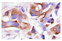  FADD (S-18): sc-6035. Immunoperoxidase staining of formalin-fixed, paraffin-embedded human breast tumor showing cytoplasmic staining.