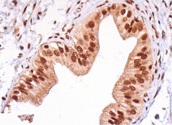  p-FADD (Ser 191): sc-33399. Immunoperoxidase staining of formalin fixed, paraffin-embedded human gall bladder tissue showing nuclear staining of glandular cells.