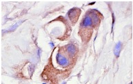  p-FADD (Ser 194): sc-12439. Immunoperoxidase staining of formalin-fixed, paraffin-embedded human breast tumor showing cytoplasmic staining.