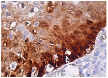  galectin-7 (G-3): sc-137085. Immunoperoxidase staining of formalin fixed, paraffin-embedded human cervix tissue showing nuclear and cytoplasmic staining of squamous epithelial cells.