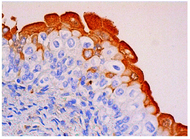  GP-39 (E-11): sc-376910. Immunoperoxidase staining of formalin fixed, paraffin-embedded human urinary bladder tissue showing cytoplasmic staining of urothelial cells.