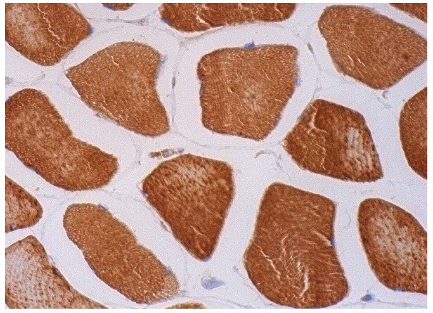  hamartin (C-8): sc-377386. Immunoperoxidase staining of formalin fixed, paraffin-embedded human skeletal muscle tissue showing cytoplasmic staining of myocytes.