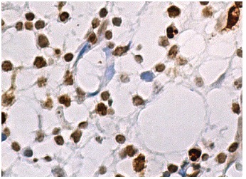  HBXIP (H-5): sc-373980. Immunoperoxidase staining of formalin fixed, paraffin-embedded human bone marrow tissue showing nuclear staining of hematopoietic cells.