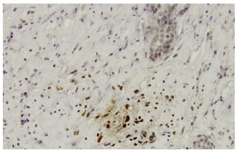  KiSS-1 (24-Q): sc-101246. Immunoperoxidase staining of formalin-fixed, paraffin-embedded human prostate tissue showing nuclear and cytoplasmic localization.