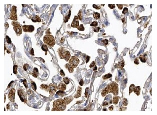  MAGE (A-16): sc-31321. Immunoperoxidase staining of formalin fixed, paraffin-embedded human lung tissue showing cytoplasmic staining of macrophages and pneumocytes at high magnification. Kindly provided by The Swedish Human Protein Atlas (HPA) program.