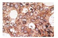  MAGE-A10 (C-23): sc-130161. Immunoperoxidase staining of formalin fixed, paraffin-embedded human cancer tissue showing cytoplasmic staining.