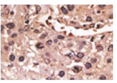  MAGE-A12 (N-17): sc-130163. Immunoperoxidase staining of formalin fixed, paraffin-embedded human cancer tissue showing cytoplasmic staining.