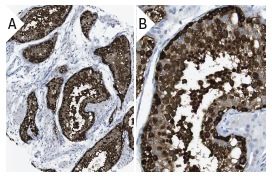  MAGE-C1 (CT7-33): sc-53868. Immunoperoxidase staining of formalin fixed, paraffin-embedded human testis tissue showing nuclear and cytoplasmic staining of cells in seminiferus ducts (low and high magnification). Kindly provided by The Swedish Human Protein Atlas (HPA) program.