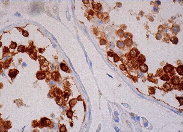  MAGE-C1 (CT7-33): sc-53868. Immunoperoxidase staining of formalin fixed, paraffin-embedded human testis tissue showing nuclear and cytoplasmic staining of cells in seminiferous ducts.