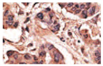  MAGE-H1 (H-21): sc-130813. Immunoperoxidase staining of formalin-fixed, paraffin-embedded human breast carcinoma tissue showing cytoplasmic localization.