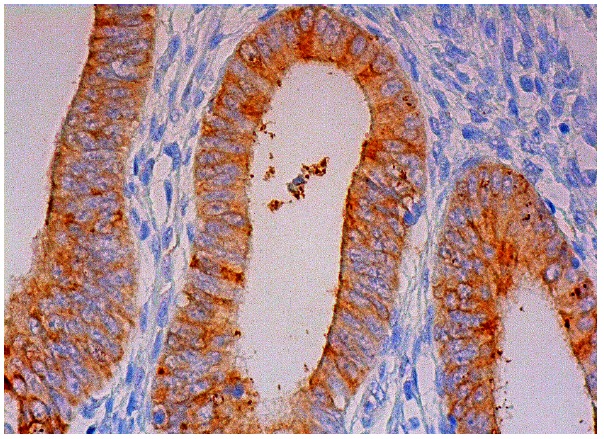  Mammaglobin B (S-18): sc-48332. Immunoperoxidase staining of formalin fixed, paraffin-embedded human pre-menopausal uterus tissue showing cytoplasmic staining of glandular cells.