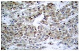  p-Bad (Ser 112): sc-101640. Immunoperoxidase staining of formalin-fixed, paraffin-embedded human breast carcinoma tissue extract showing cytoplasmic staining.