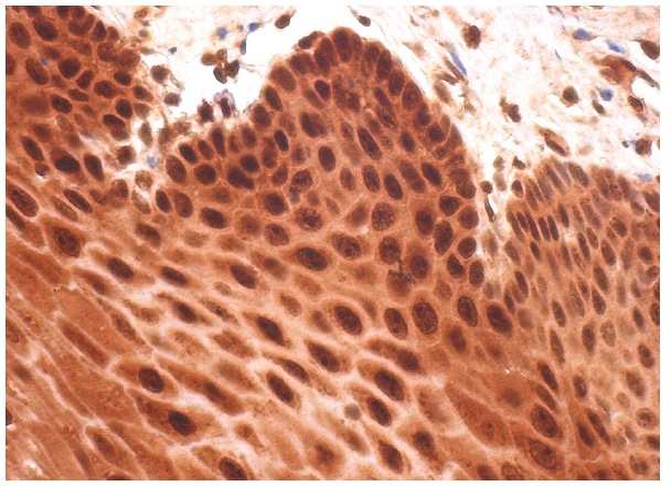  Nucleostemin (H-270): sc-67012. Immunoperoxidase staining of formalin fixed, paraffin-embedded human esophagus tissue showing nucleolar, nuclear and cytoplasmic staining of squamous epithelial cells.