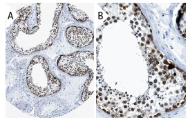  NY-ESO-1 (E978): sc-53869. Immunoperoxidase staining of formalin fixed, paraffin-embedded human testis tissue showing nuclear and cytoplasmic staining of cells in seminiferus ducts (low and high magnification). Kindly provided by The Swedish Human Protein Atlas (HPA) program.