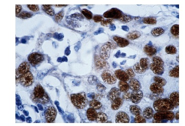  p53 (DO-1): sc-126. Immunoperoxidase staining of formalin-fixed, paraffin-embedded human breast carcinoma tissue. Note intense nuclear staining of ductal epithelia. 