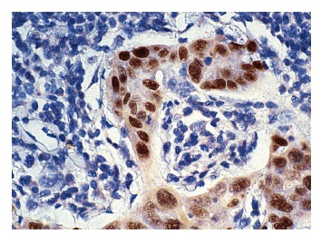  p53 (FL-393): sc-6243. Immunoperoxidase staining of formalin-fixed, paraffin-embedded human breast carcinoma tissue. Note nuclear staining of ductal epithelial.