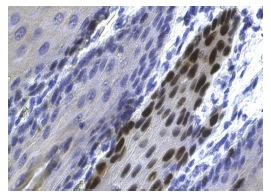  p53 (FL-393): sc-6243. Immunoperoxidase staining of formalin fixed, paraffin-embedded human esophagus tissue showing nuclear staining of squamous epithelial cells.