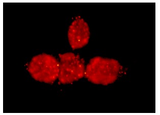  p53 (Pab 1801): sc-98. Immunoperoxidase staining of formalin-fixed, paraffin-embedded human breast carcinoma tissue (A) and immunofluorescence staining of methanol-fixed A-431 cells (B) showing nuclear staining.