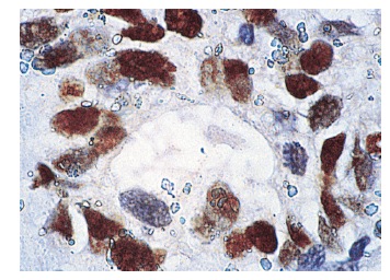  p53 (Pab 1801): sc-98. Immunoperoxidase staining of formalin-fixed, paraffin-embedded human breast carcinoma tissue (A) and immunofluorescence staining of methanol-fixed A-431 cells (B) showing nuclear staining.