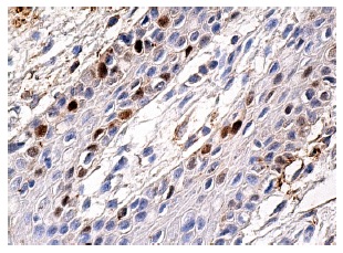  p53 (B-P3): sc-65334. Immunoperoxidase staining of formalin fixed, paraffin-embedded human oral mucosa tissue showing nuclear staining of subset of squamous epithelial cells.