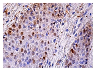  p53 (BP 53.12): sc-81168. Immunoperoxidase staining of formalin fixed, paraffin-embedded human oral mucosa tissue showing nuclear staining of subset of squamous epithelial cells.