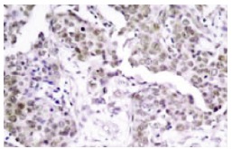  p-p53 (Ser 15): sc-101762. Immunoperoxidase staining of formalin-fixed, paraffin-embedded human breast carcinoma tissue showing nuclear staining.