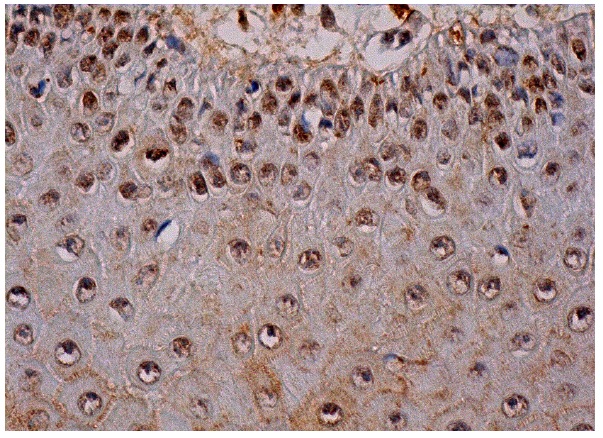  p-p53 (Ser 392): sc-7997. Immunoperoxidase staining of formalin fixed, paraffin-embedded oral mucosa tissue showing nuclear, cytoplasmic and membrane staining of squamous epithelial cells.