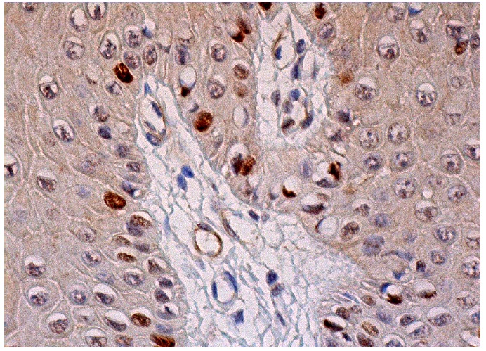  p-p53 Antibody (Thr 55)-R: sc-12904-R. Immunoperoxidase staining of formalin fixed, paraffin-embedded human oral mucosa tissue showing nuclear staining of subset of squamous epithelial cells.