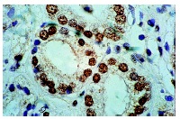  PAR4 (A-10): sc-1666. Immunoperoxidase staining of formalin-fixed, paraffin-embedded human prostate carcinoma tissue. Note nuclear staining of glandular epithelial cells.