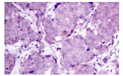  p-PTEN (Ser 380): sc-101788. Immunoperoxidase staining of formalin-fixed, paraffin-embedded human breast carcinoma tissue showing cytoplasmic staining.