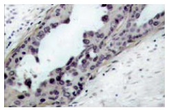  p-PTEN (Ser 380/Thr 382/383): sc-101789. Immunoperoxidase staining of formalin-fixed, paraffin-embedded human breast carcinoma tissue showing cytoplasmic staining.