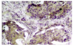  p-PTEN (Ser 370): sc-101787. Immunoperoxidase staining of formalin-fixed, paraffin-embedded human breast carcinoma tissue showing cytoplasmic staining.