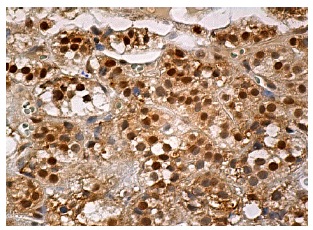  Rad23B (C-4): sc-166507. Immunoperoxidase staining of formalin fixed, paraffin-embedded human adrenal gland tissue showing cytoplasmic and nuclear staining of glandular cells.