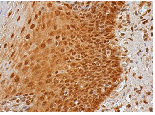  Rad23B (H-120): sc-67225. Immunoperoxidase staining of formalin fixed, paraffin-embedded human esophagus tissue showing nuclear and cytoplasmic staining of squamous epithelial cells.