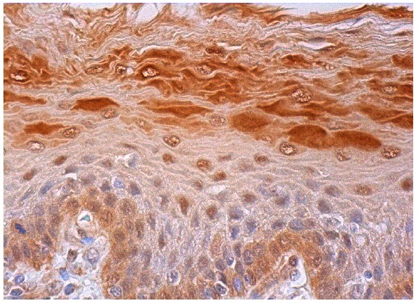  Rad23B (N-12): sc-49041. Immunoperoxidase staining of formalin fixed, paraffin-embedded human esophagus tissue showing nuclear and cytoplasmic staining of squamous epithelial cells.