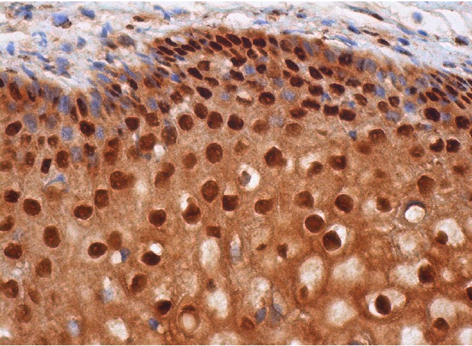  p-Rb (A-5): sc-377528. Immunoperoxidase staining of formalin fixed, paraffin-embedded human vagina tissue showing nuclear and cytoplasmic staining of squamous epithelial cells.