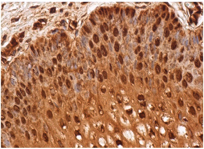  p-Rb (B-7): sc-377527. Immunoperoxidase staining of formalin fixed, paraffin-embedded human vagina tissue showing nuclear and cytoplasmic staining of squamous epithelial cells.