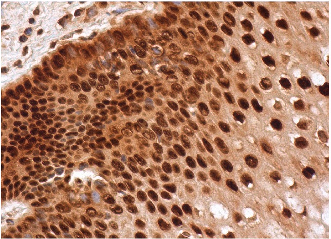  p-Rb (C-3): sc-377524. Immunoperoxidase staining of formalin fixed, paraffin-embedded human vagina tissue showing nuclear and cytoplasmic staining of squamous epithelial cells.