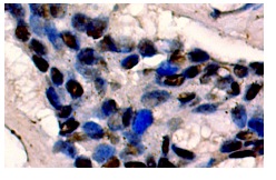  p-Rb (Ser 249/Thr 252): sc-16671. Immunoperoxidase staining of formalin fixed, paraffin-embedded human breast tumor showing nuclear localization.