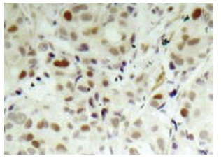  p-Rb (Ser 807): sc-293117. Immunoperoxidase staining of formalin-fixed, paraffin-embedded human breast carcinoma tissue showing nuclear localization.