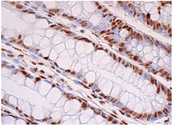  p-Rb (Thr 821/826)-R: sc-16669-R. Immunoperoxidase staining of formalin fixed, paraffin-embedded human rectum tissue showing nuclear staining of glandular cells.