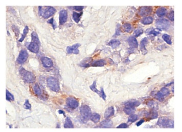  TANK (N-19): sc-1998. Immunoperoxidase staining of formalin-fixed, paraffin-embedded human lung tumor showing cytoplasmic staining.